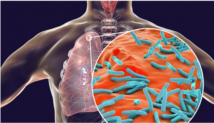 छत्तीसगढ़ में 10 दिनों में टीबी के 1,520 नए मरीज आए सामने
